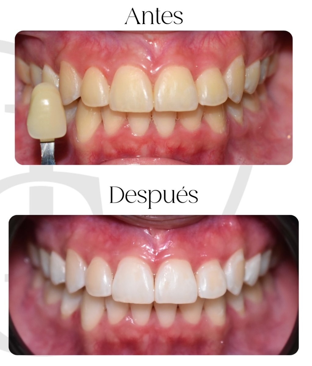 Resultados de blanqueamiento dental antes y después – dientes visiblemente más blancos
