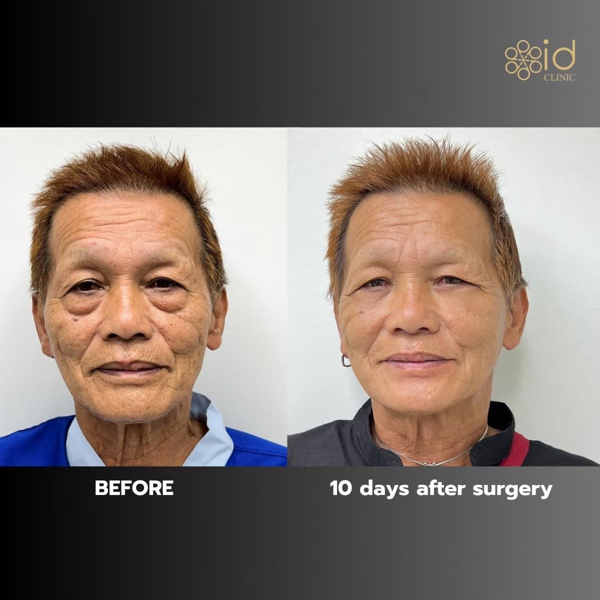 نتائج رأب الجفن السفلي قبل وبعد في ID Clinic Bangkok بعد 10 أيام من الجراحة