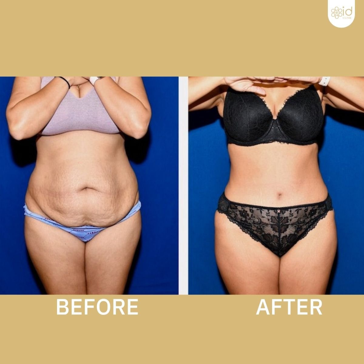 Resultados de abdominoplastia antes y después en ID Clinic Bangkok, mejora del contorno abdominal