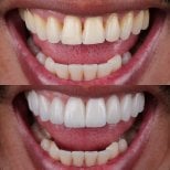 Before and after veneers result – smile transformation with whiter, even teeth