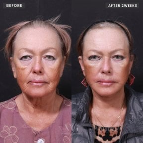 Efekty liftingu twarzy przed i po w VG Plastic Surgery – odmłodzenie po 2 tygodniach