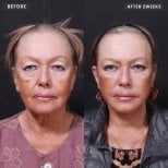 Efekty liftingu twarzy przed i po w VG Plastic Surgery – odmłodzenie po 2 tygodniach