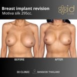 Before and after breast implant revision results with Motiva 295cc at ID Clinic Bangkok