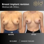 Before and after breast implant revision with Motiva 355cc at ID Clinic Bangkok results