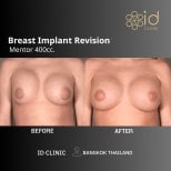 Before and after breast implant revision results at ID Clinic Bangkok with Mentor 400cc implants