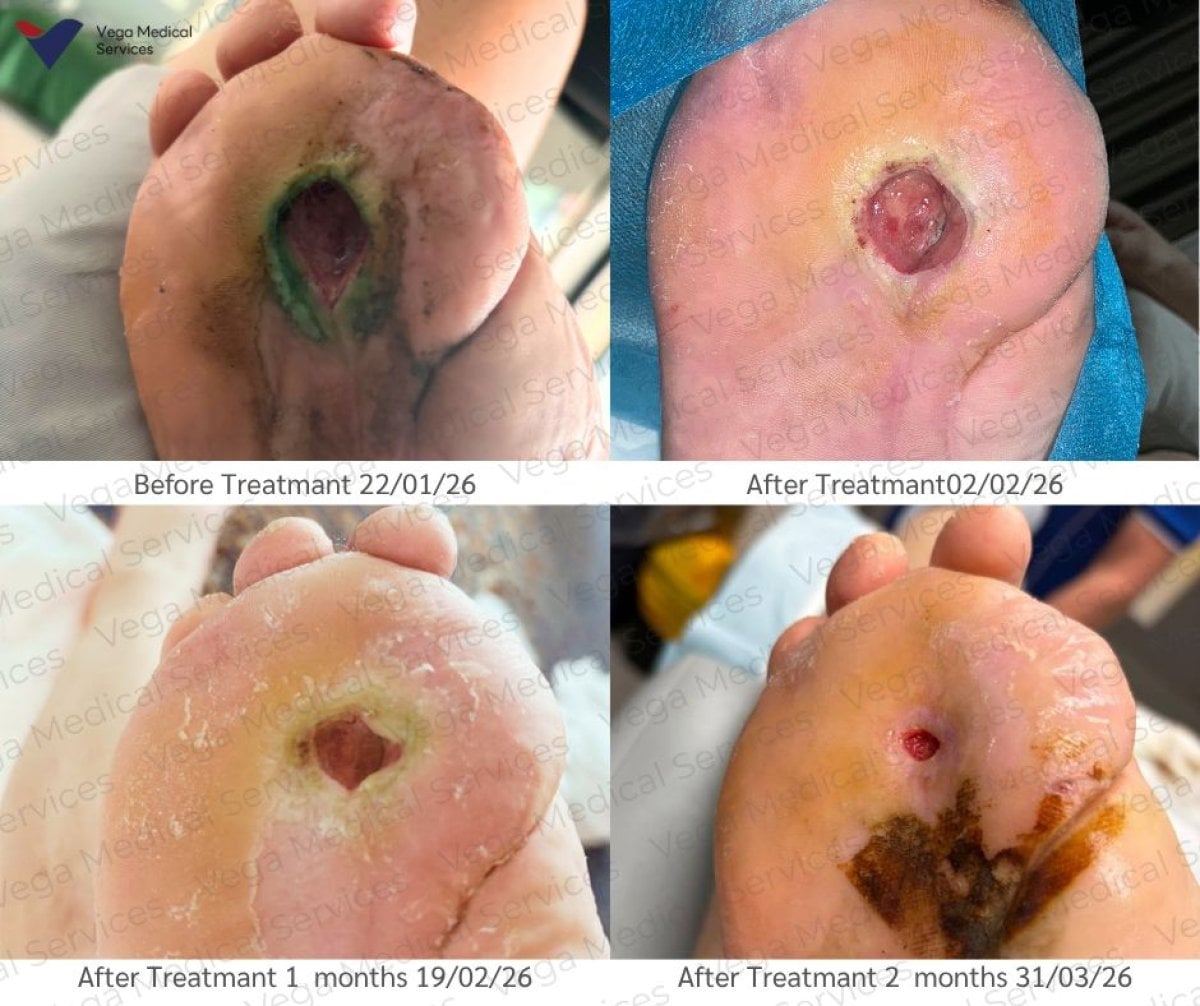 Antes y después de terapia con células madre para úlcera en pie en Vega Clinic, recuperación visible