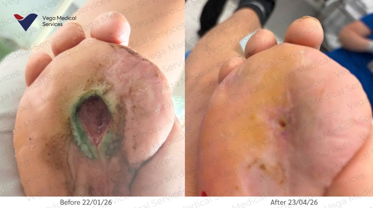 Antes y después de terapia con células madre para úlcera en pie en Vega Clinic, resultado visible