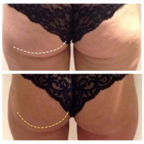 Before and after fillers injection at Klinika La Perla, buttock contour enhancement result