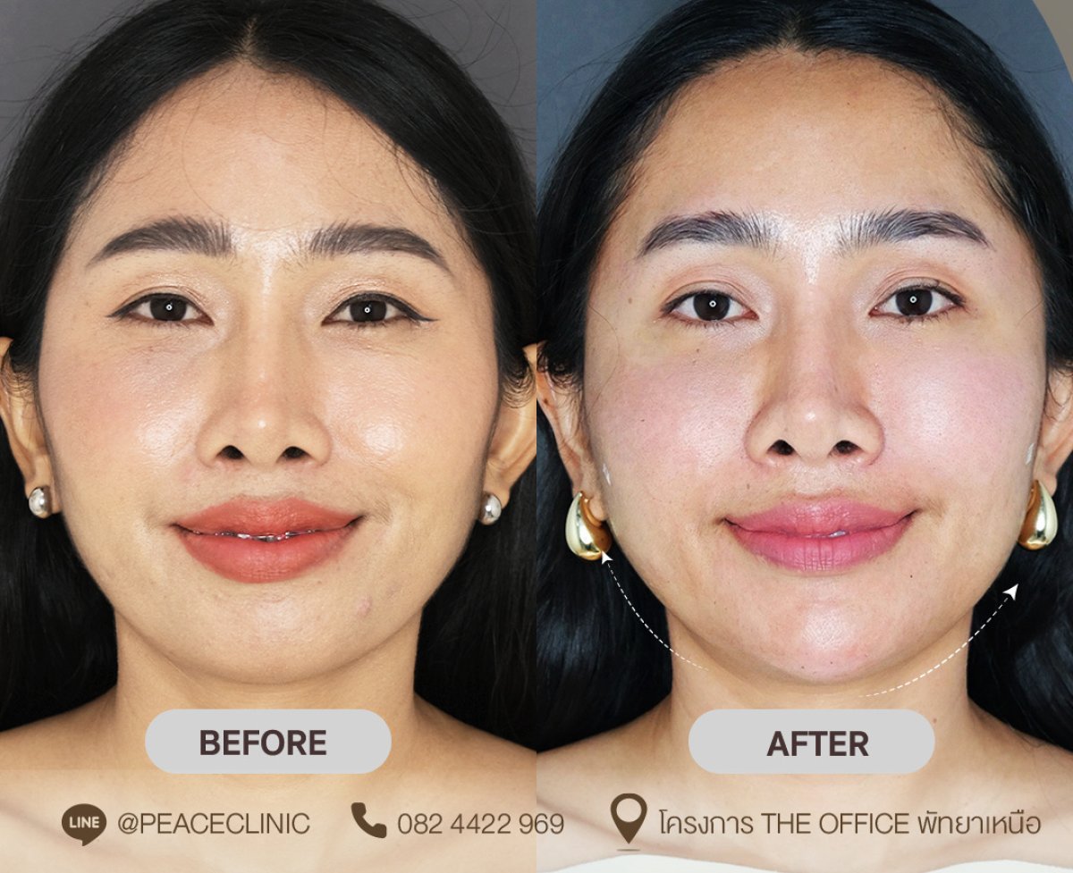 Resultados antes y después de rellenos en Peace Clinic: mejora del contorno facial