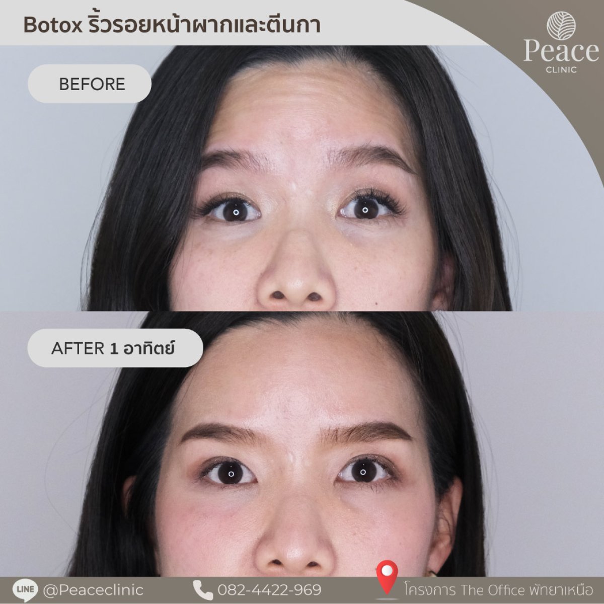 Resultados antes y después de Botox para arrugas en la frente en Peace Clinic, alisado visible
