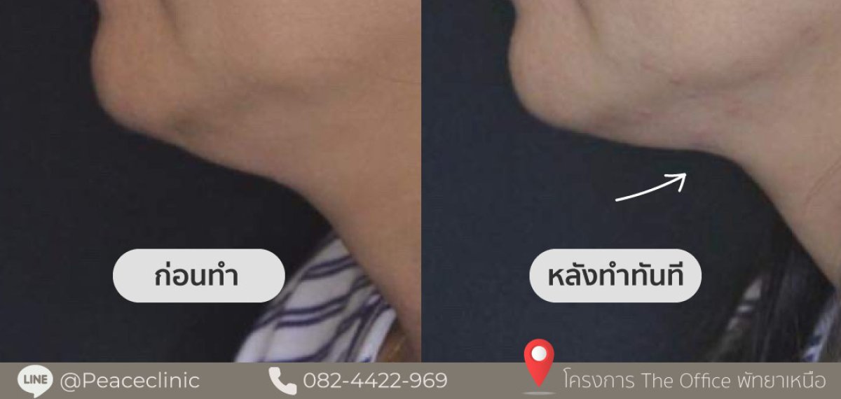 نتائج قبل وبعد إذابة الدهون في Peace Clinic – تقليل الذقن المزدوجة وتحديد الفك