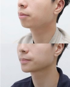 before-after photo jawline-contouring