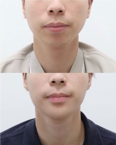 before-after photo jawline-contouring