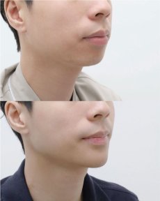 before-after photo jawline-contouring