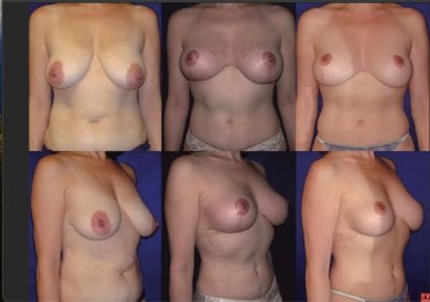 before-after photo breast-implants-with-breast-lift