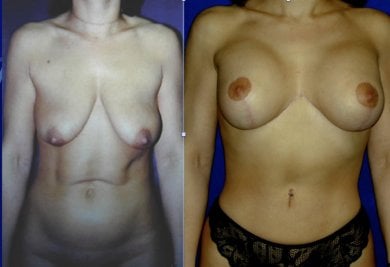 before-after photo breast-implants-with-breast-lift