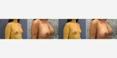 before-after photo breast-implants-with-breast-lift