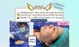 قبل عملية تجميل الأنف مع إعادة بناء الأنف في عيادة Seoul Review، نتيجة من الجانب