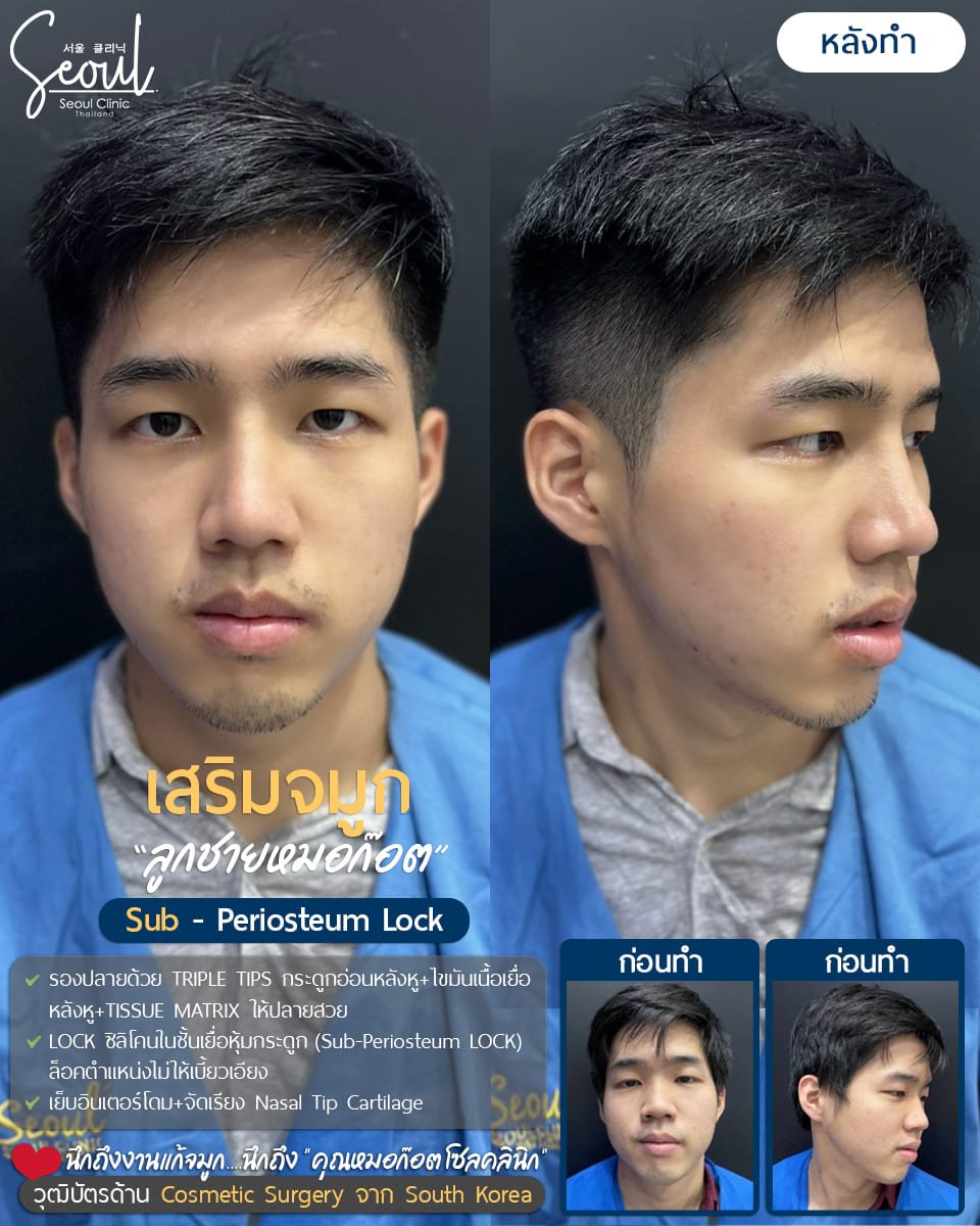 Resultados de rinoplastia antes y después en Seoul Clinic Thailand, mejora de la forma nasal