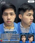 نتائج عملية تجميل الأنف قبل وبعد في Seoul Clinic Thailand، تحسين شكل الأنف