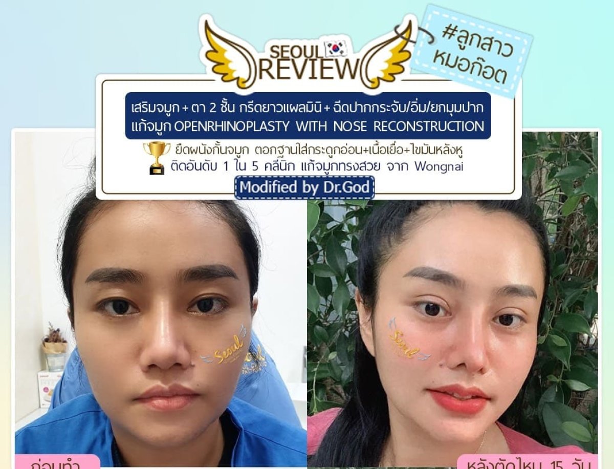 قبل وبعد عملية تجميل وإعادة بناء الأنف في Seoul Review، نتيجة واضحة لتغيير الأنف