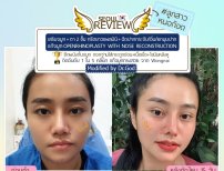 قبل وبعد عملية تجميل وإعادة بناء الأنف في Seoul Review، نتيجة واضحة لتغيير الأنف