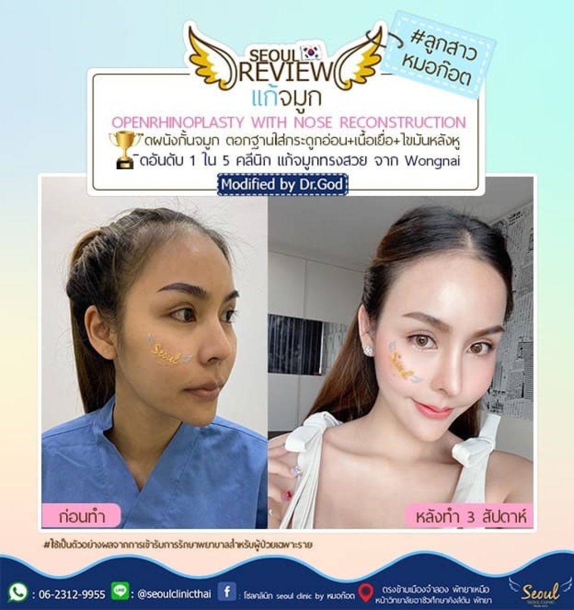 Resultado antes y después de rinoplastia abierta en Seoul Clinic, remodelación y reconstrucción nasal