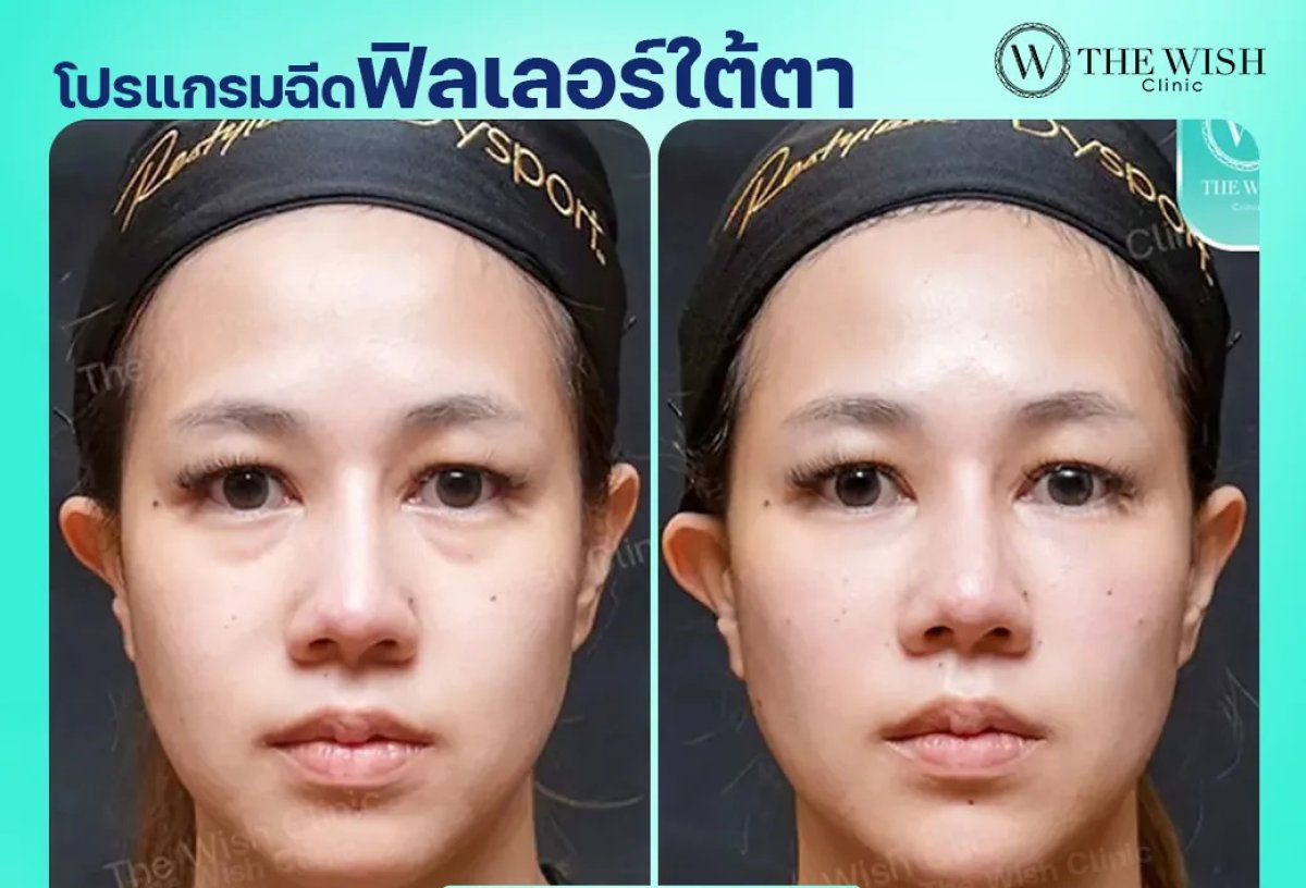 نتائج قبل وبعد حقن الفيلر تحت العين في The Wish Clinic، منطقة عين أكثر نعومة