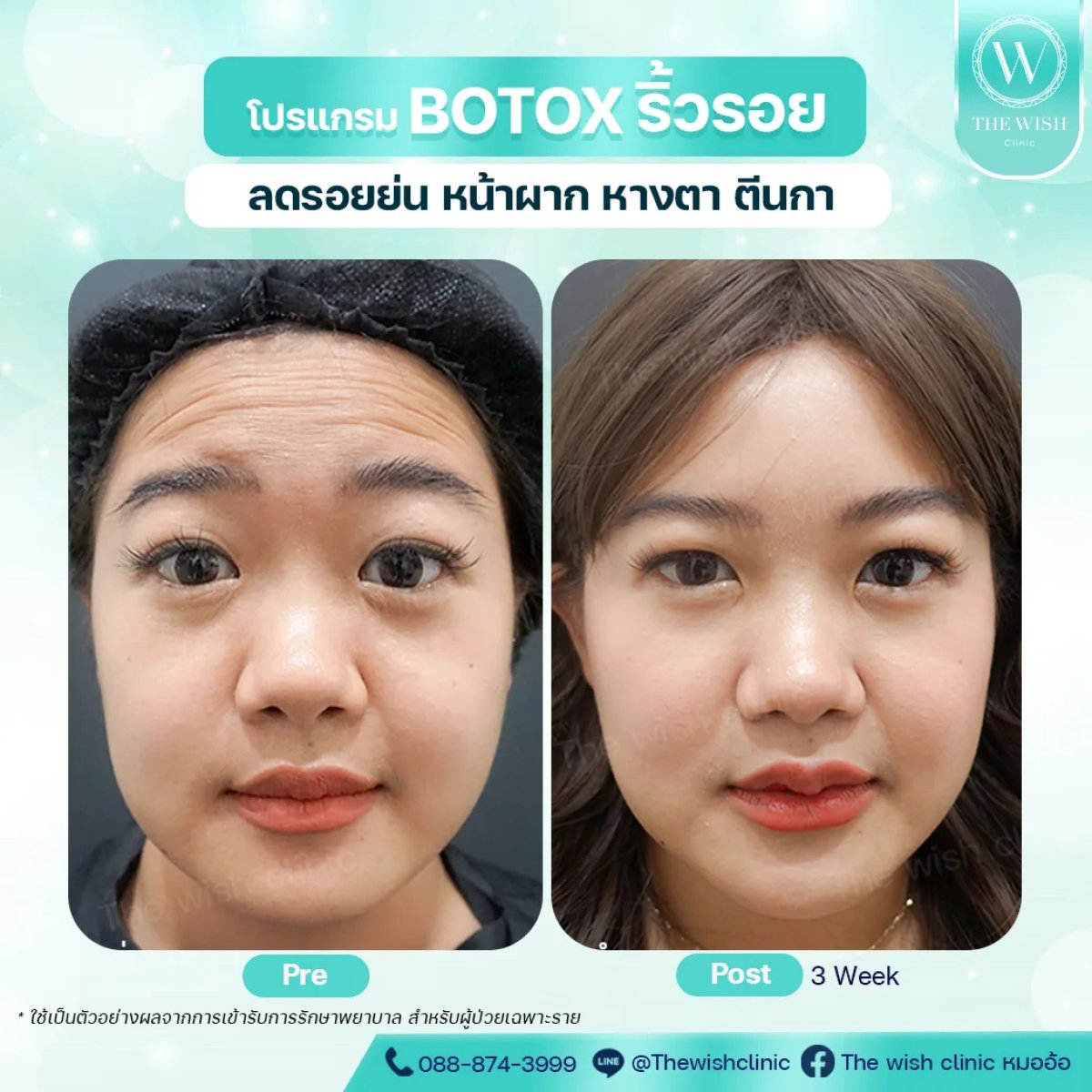 Antes y después de botox en The Wish Clinic: frente más lisa y menos arrugas