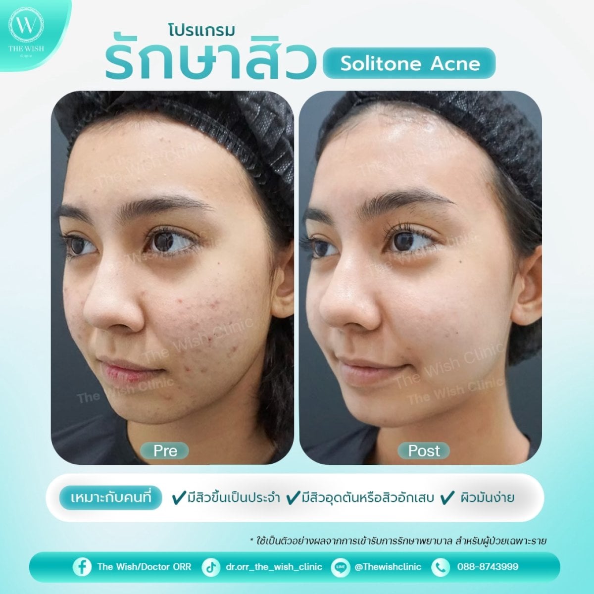 نتائج علاج ندبات حب الشباب قبل وبعد في The Wish Clinic باستخدام Solitone Acne