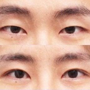 before-after photo blepharoplasty-eyelid