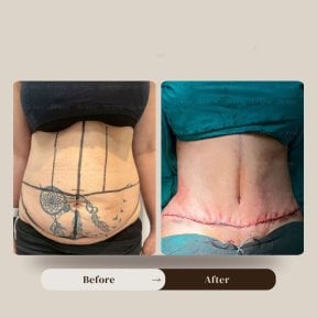 before-after photo abdominoplasty