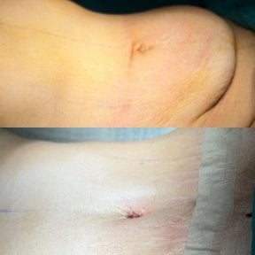 before-after photo tummy-tuck-and-liposuction