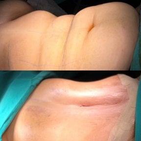 before-after photo tummy-tuck-and-liposuction