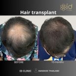 نتائج قبل وبعد زراعة الشعر DHI في ID Clinic Bangkok مع تحسن كثافة الشعر