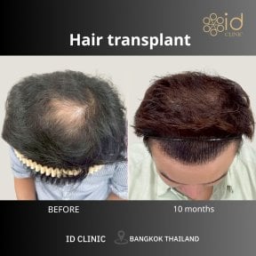 نتيجة زراعة الشعر DHI قبل وبعد في ID Clinic Bangkok بعد 10 أشهر من الإجراء
