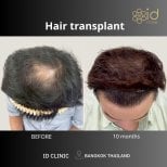 نتيجة زراعة الشعر DHI قبل وبعد في ID Clinic Bangkok بعد 10 أشهر من الإجراء
