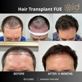 نتائج زراعة الشعر FUE قبل وبعد في ID Clinic Bangkok، استعادة خط الشعر بوضوح