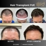 نتائج زراعة الشعر FUE قبل وبعد في ID Clinic Bangkok، استعادة خط الشعر بوضوح