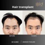 نتائج زراعة الشعر DHI قبل وبعد في ID Clinic Bangkok، تحسن خط الشعر خلال 14 يومًا