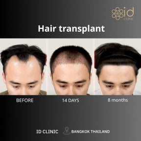 نتائج زراعة الشعر DHI قبل وبعد في ID Clinic Bangkok، استعادة خط الشعر بوضوح