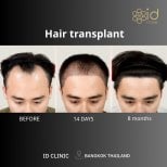 نتائج زراعة الشعر DHI قبل وبعد في ID Clinic Bangkok، استعادة خط الشعر بوضوح