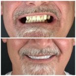 Avant/après pose de couronnes zircone à SUAVE DENTAL CLINIC, résultat sourire