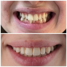 Résultats avant et après Invisalign à SUAVE DENTAL CLINIC, amélioration de l’alignement dentaire