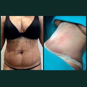Before and after tummy tuck and liposuction results at Grand Clinic – flatter abdomen