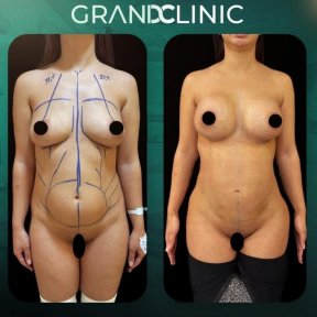 Résultats avant et après liposuccion Vaser à Grand Clinic – amélioration visible de la silhouette