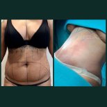 Résultats avant/après liposuccion Vaser à Grand Clinic – amélioration du contour abdominal