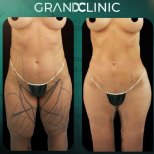 Résultats avant et après liposuccion Vaser à Grand Clinic, amélioration du contour du corps