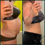 До та після ліпосакції в Grand Clinic, помітний результат контурингу живота