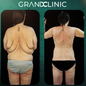 До и после круговой подтяжки тела в Grand Clinic, видимый результат улучшения спины
